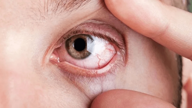 Persistent redness of the eyes, a burning and scratchy sensation, sensitivity to light, a pressure on the eye and eye fatigue are symptoms of dry eyes syndrome.