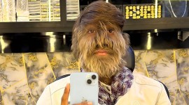 lalit patidar has werewolf syndrome