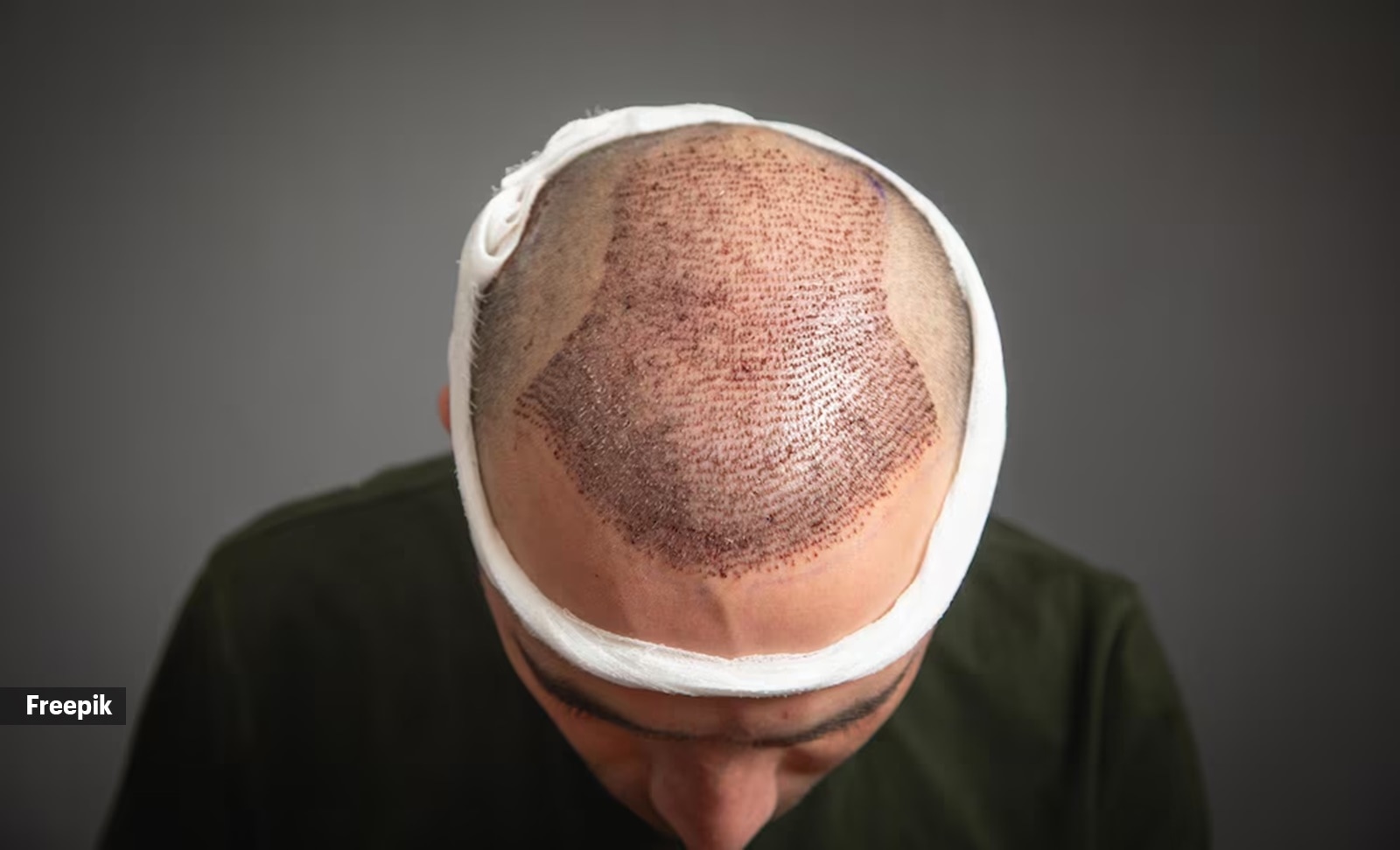 Hair transplant surgery is suggested for advancing