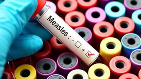 Measles