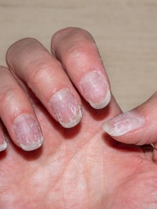 Struggling with hair thinning and Brittle nails? Check your selenium levels