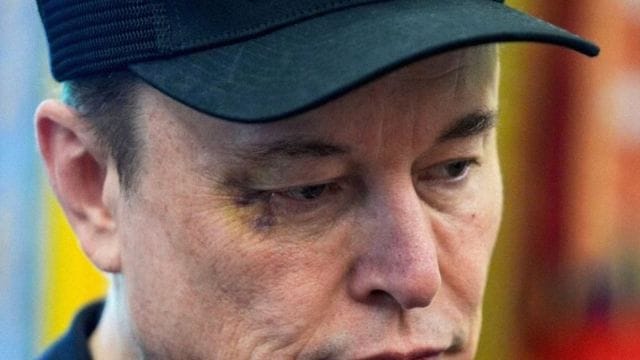 Elon Musk bruised eye