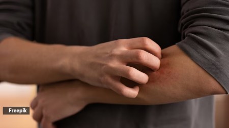 desi nuskhas to cure bee stings