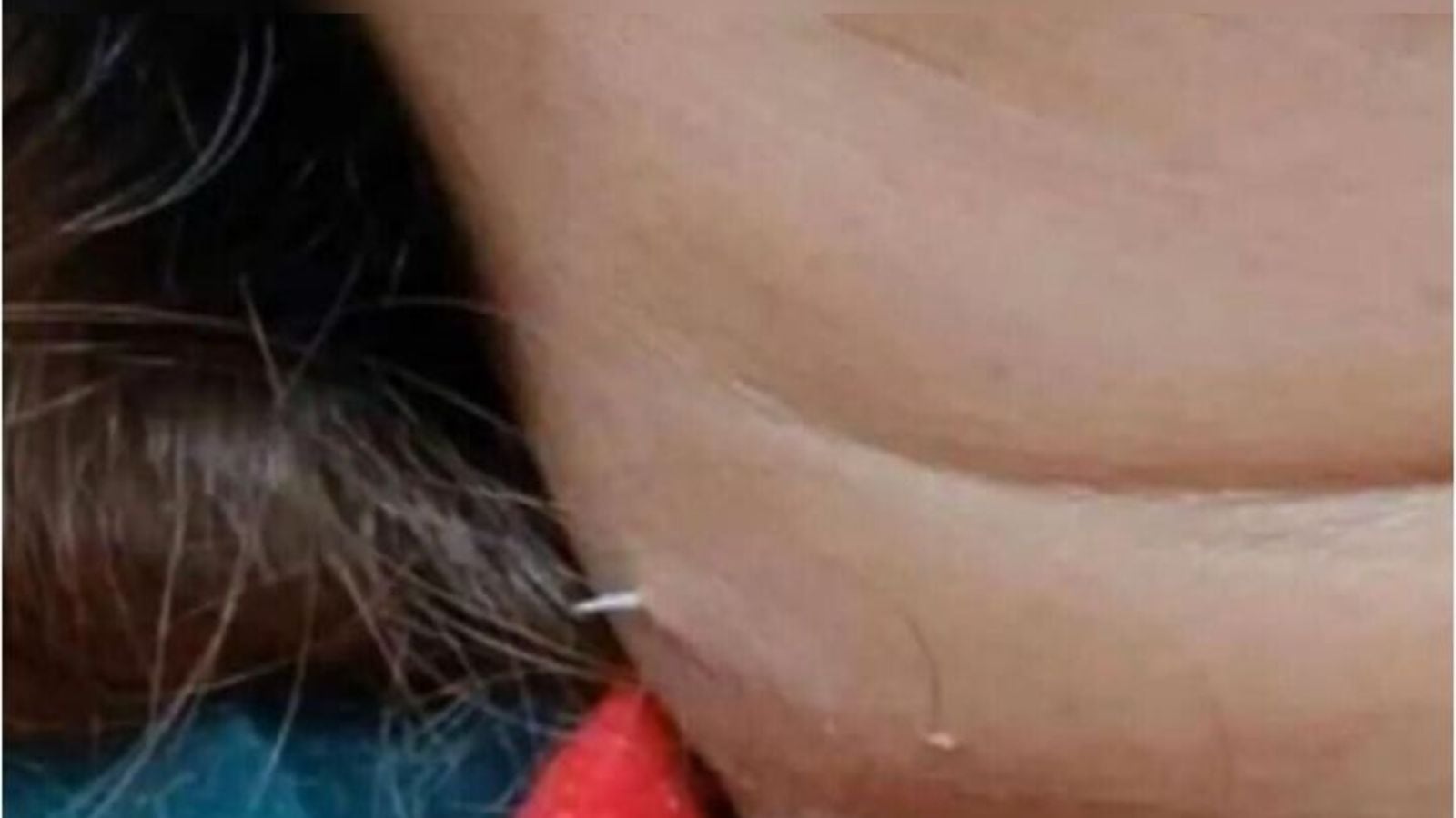 Fishbone stuck in Thai woman’s throat pierces neck after failed home remedies