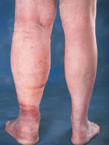 8 Warning Signs of Vein Disease that could Point to Serious Health Issues