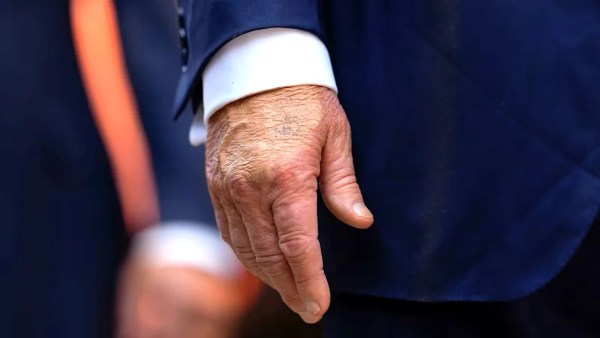 Trump photographed with sizeable bruise on right hand