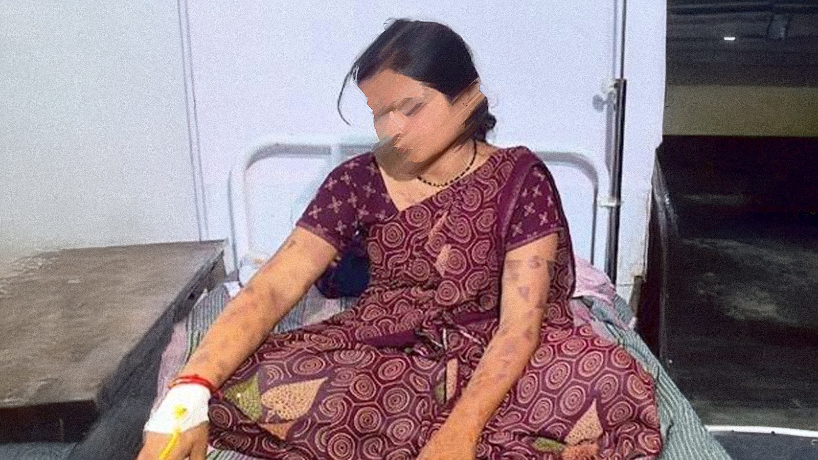 Branded more than 50 times with hot knife over dowry demands