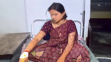 Branded more than 50 times with hot knife over dowry demands