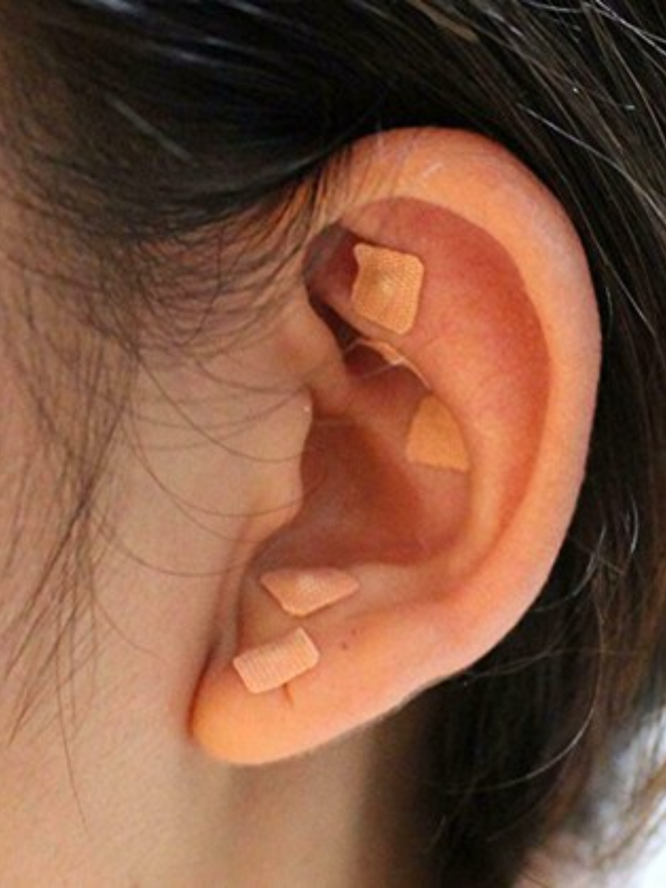Ear Seeding for Stress, Sleep: Place and Press