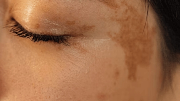 health, skin
