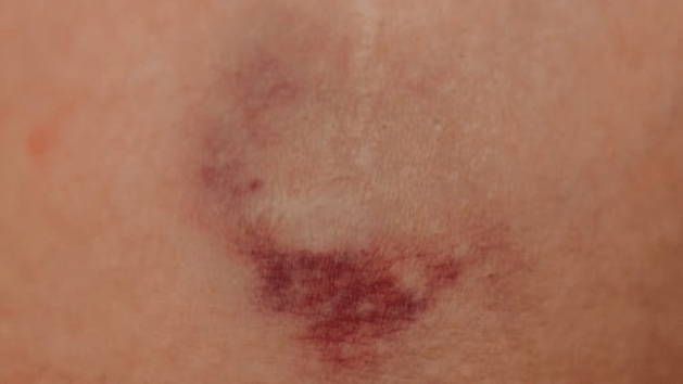 health, swelling