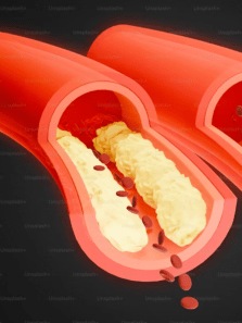 Signs that indicate you have blocked arteries
