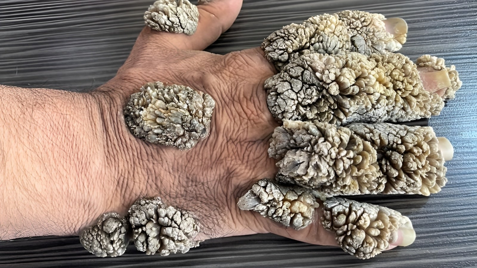 This rare genetic disorder causes tree-bark like lesions on skins: Dermatologist explains causes, prevention, impact