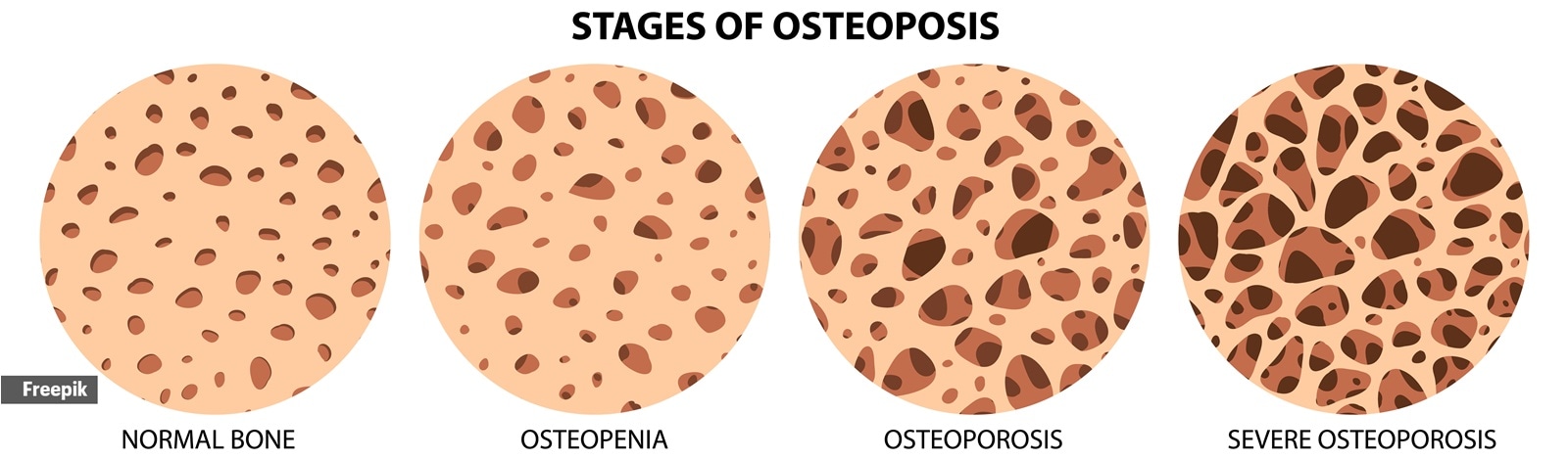 Indian women often undergo early menopause and multiple pregnancies, both of which reduce bone strength