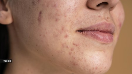 Adult acne has become very common