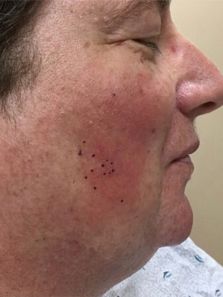 Top 8 symptoms that might indicate the onset of Lupus