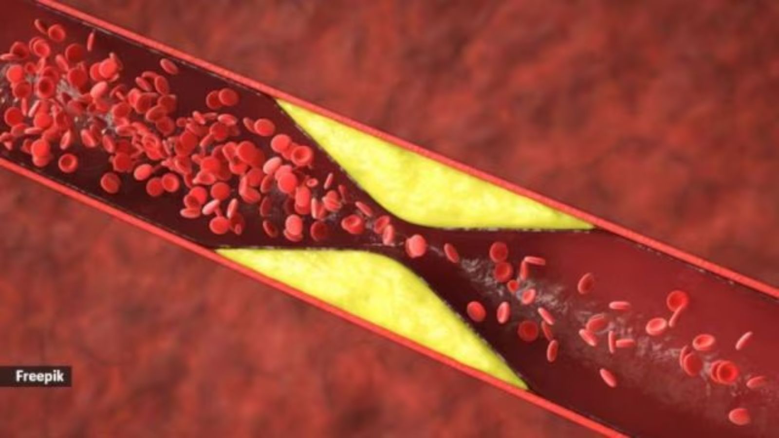 Patient's Heart Block Linked to Stopping LDL Drug, Using Garlic Supplements