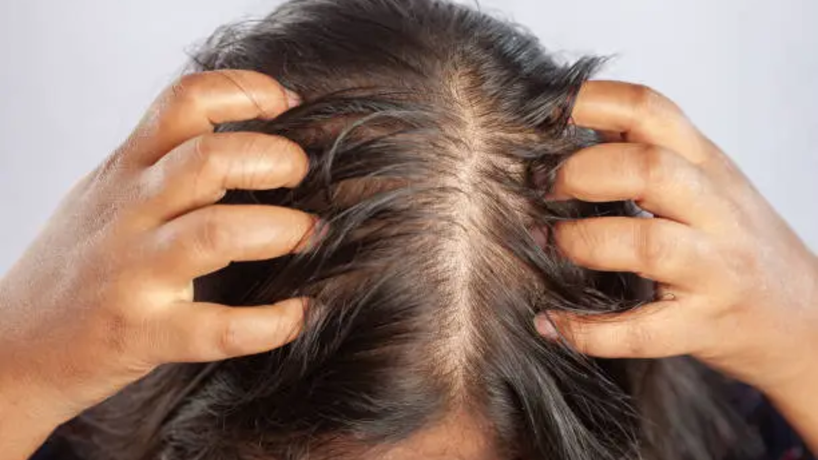 Excessive Sugar Intake Linked to Hair Loss