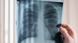 lung cancer Lung scan