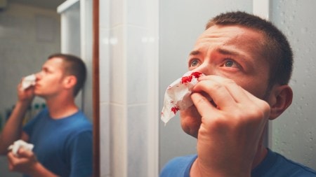 nose bleed