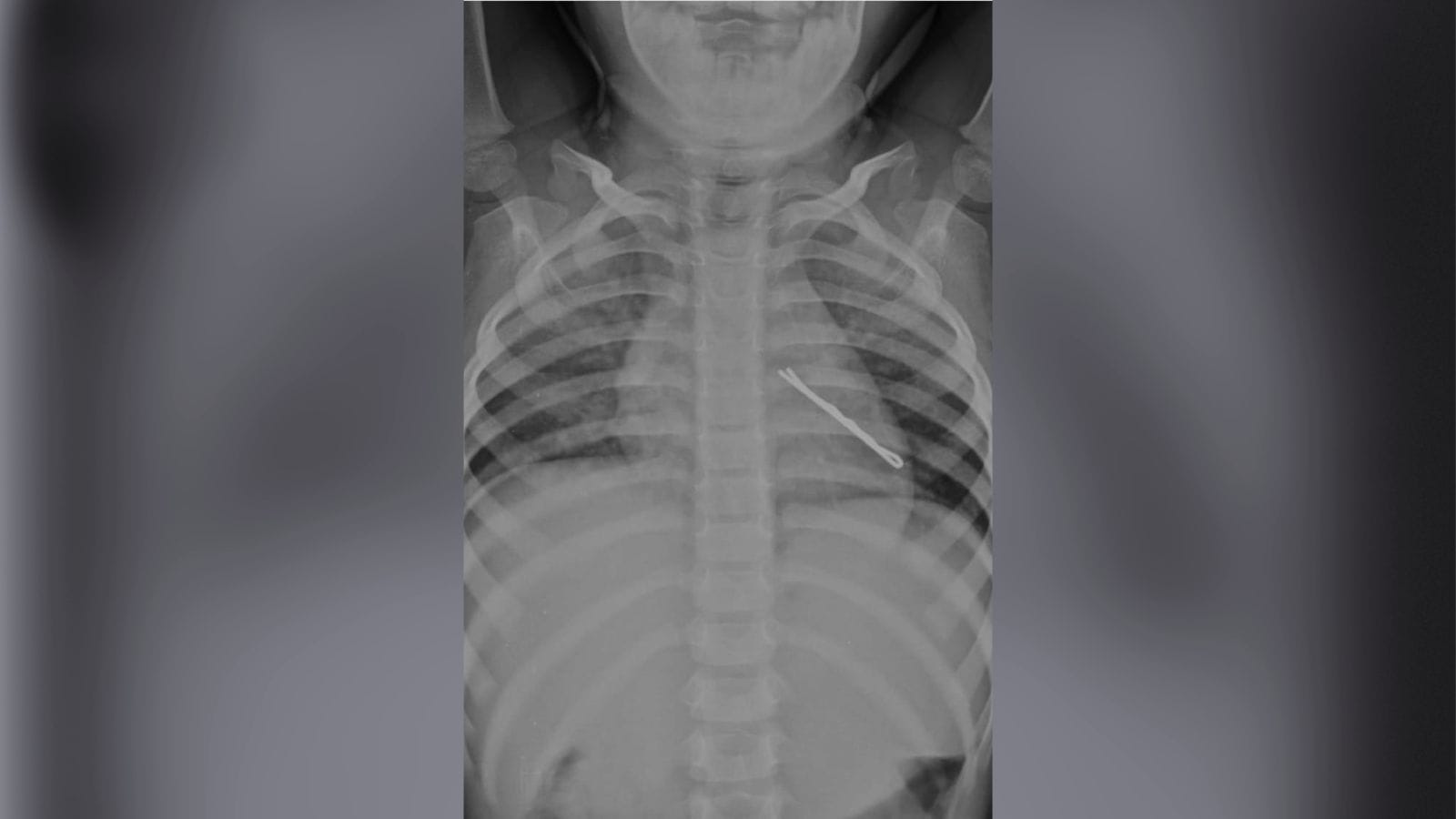 Removal of a 5 cm long hairpin from the pulmonary airway of a 3-year-old child