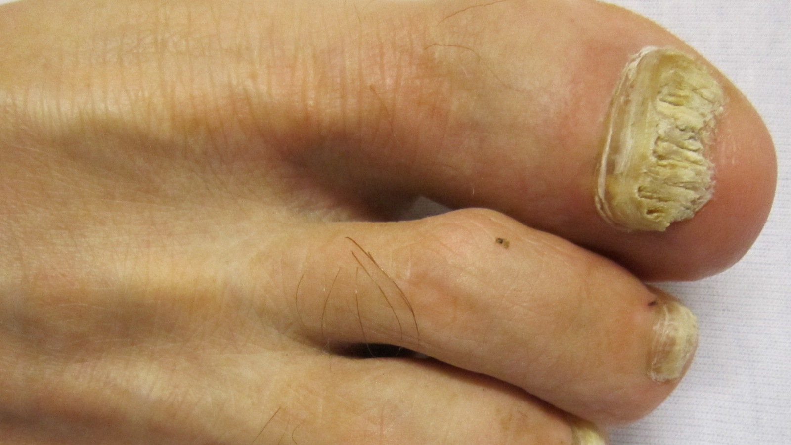 6 signs on nails you should not ignore