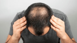 hair transplant
