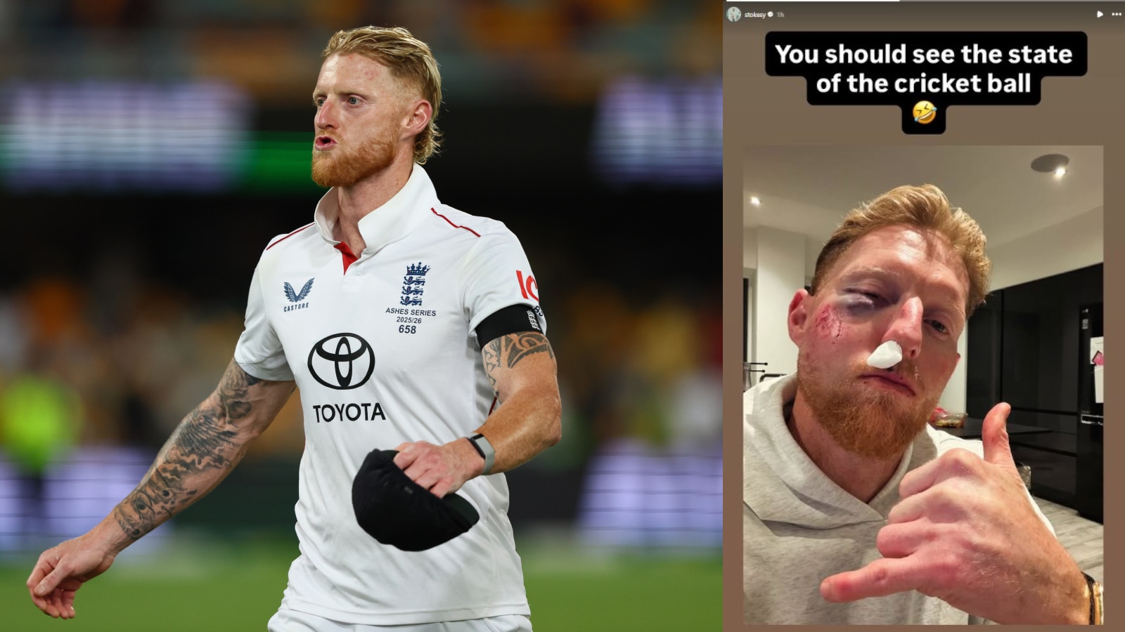 Ben Stokes Shows Off Injuries from Training Mishap