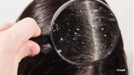 Dandruff