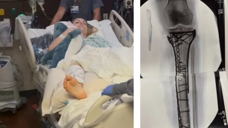 (LEFT) Lindsey Vonn being wheeled into surgery; (RIGHT) An X-ray of Vonn's leg after her accident in an alpine ski women's downhill race, at the 2026 Winter Olympics, in Cortina d'Ampezzo. (AP Photo)
