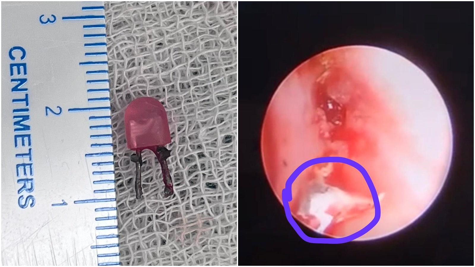 Vadodara doctors stunned as 1-year-old’s ‘pneumonia’ turns out to be a LED bulb lodged in lung