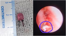 vadodara led bulb in lung