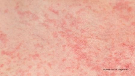 The rising temperatures often trigger several skin problems, heat rash being one of the most common issues