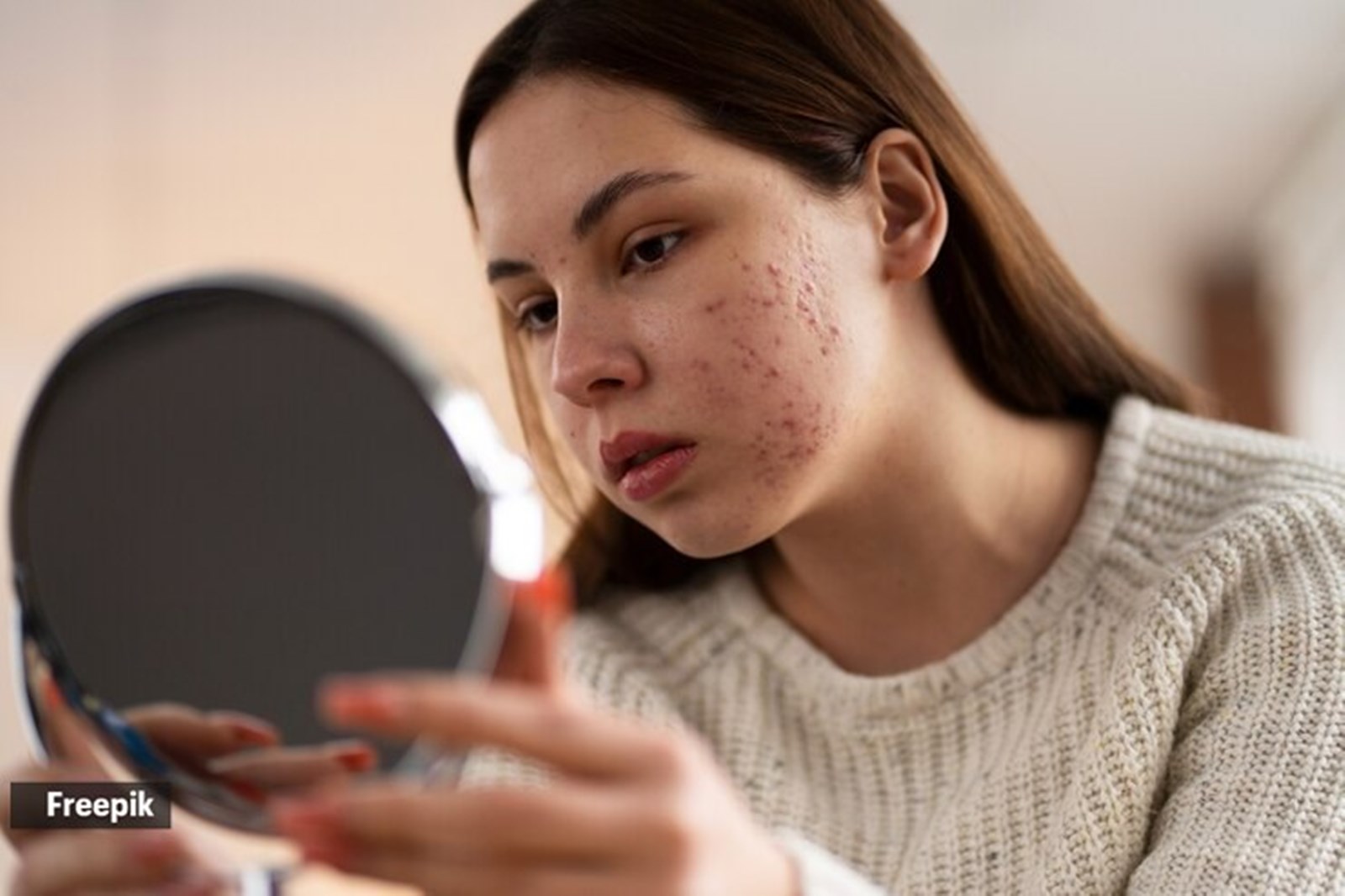 Post-Makeup Acne
