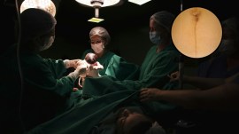 cesarean