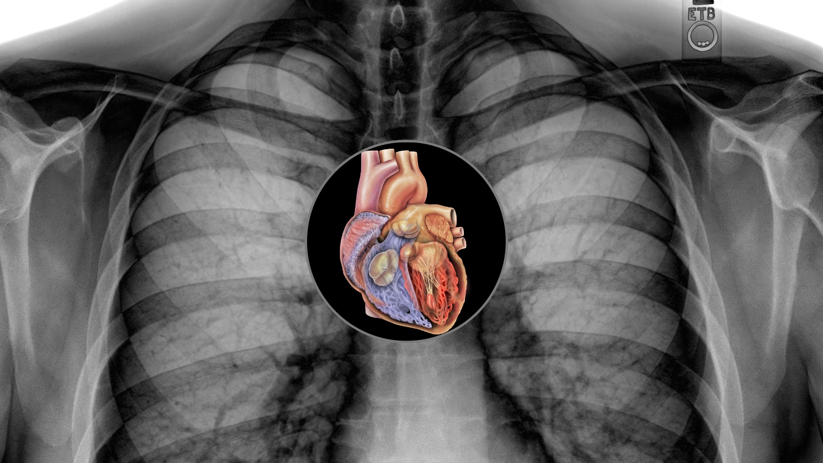 ‘It was found in an X-ray that my heart is bigger than normal, but doctor said it was just fine. What factors could make heart enlargement turn out to be fine?’