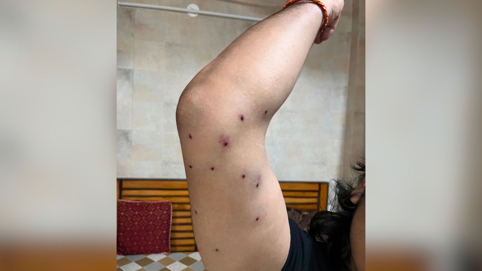 Journalist Injured in Delhi Protest: Over 30 Pellets Still Lodged, Seeks Compensation