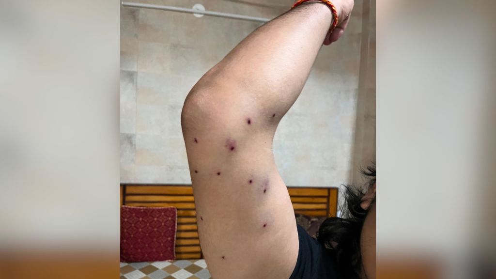 Delhi CJP protest pellets police firing