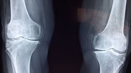 Doctor explains weather-related joint pain