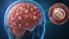 A UK woman who was found to have 38 parasite cysts in her brain after developing seizures has brought renewed attention to neurocysticercosis, a parasitic brain infection caused by the pork tapeworm.
