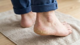 cracked heels