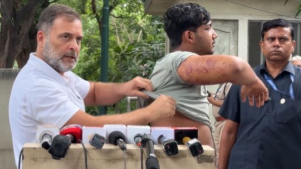 Lifting Sahil’s T-shirt to show his injuries to the media, Gandhi said the teenager also risked losing vision in one of his eyes that was damaged by pellets.