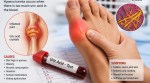 high uric acid