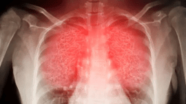 She landed after a 14-hour flight. Forty minutes later, a blood clot reached her lungs