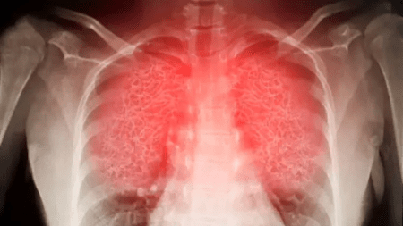 She landed after a 14-hour flight. Forty minutes later, a blood clot reached her lungs