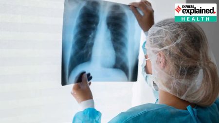 tuberculosis