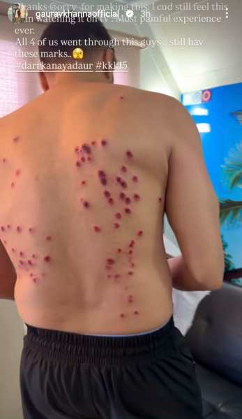 Gaurav Khanna gets severely injured on KKK 15