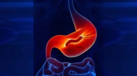 stomach cancer