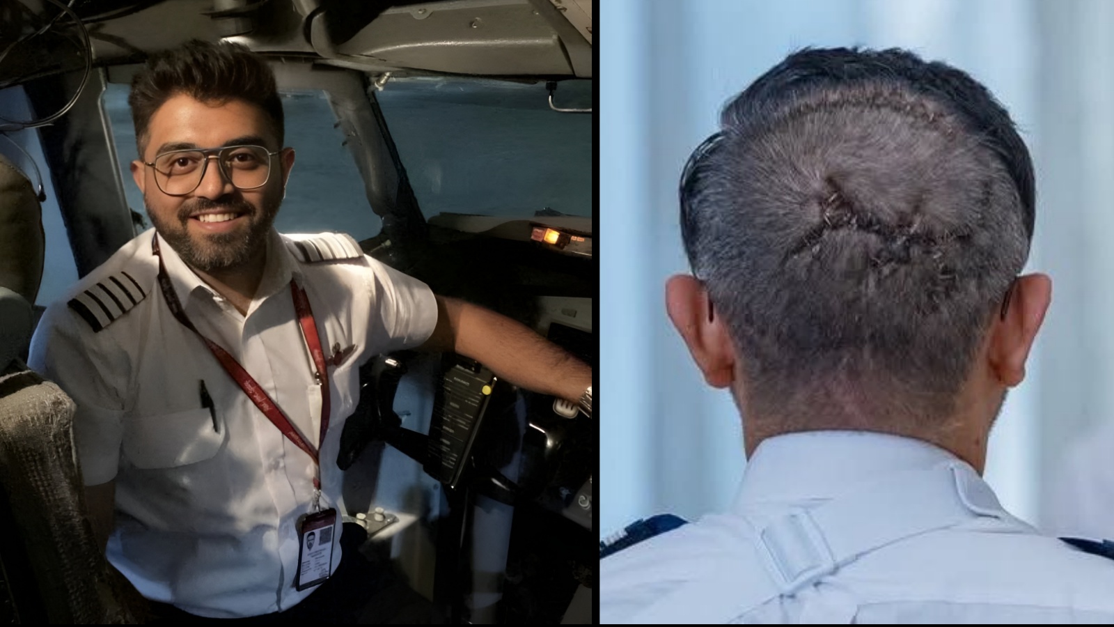 Why Captain Smit Machchhar's skull fracture was so dangerous, explained