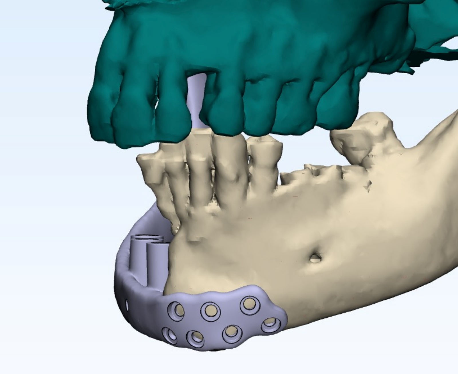Jaw reconstruction combined with vascularised soft-tissue coverage to support oral function and healing.